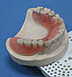 Removable partial denture