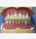 Complete prosthesis( full unbroken acrylic’s denture)